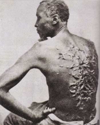 Cicatrices de flagellation d'un esclave - Creative Commons